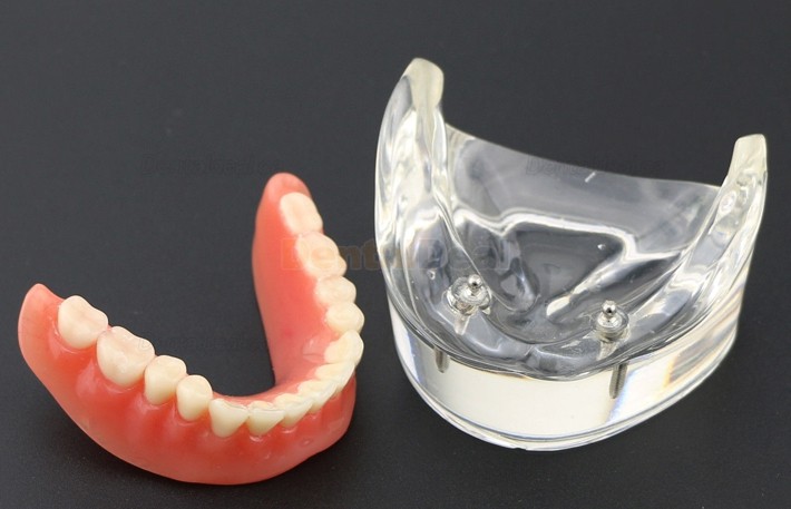 Dental Teeth Implant Overdenture Model Lower Jaw with 2 Implants Education Study Demo Model 6002 01